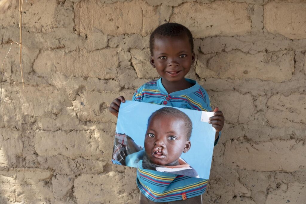 The truth about cleft lip and cleft palate: Tourism Focus