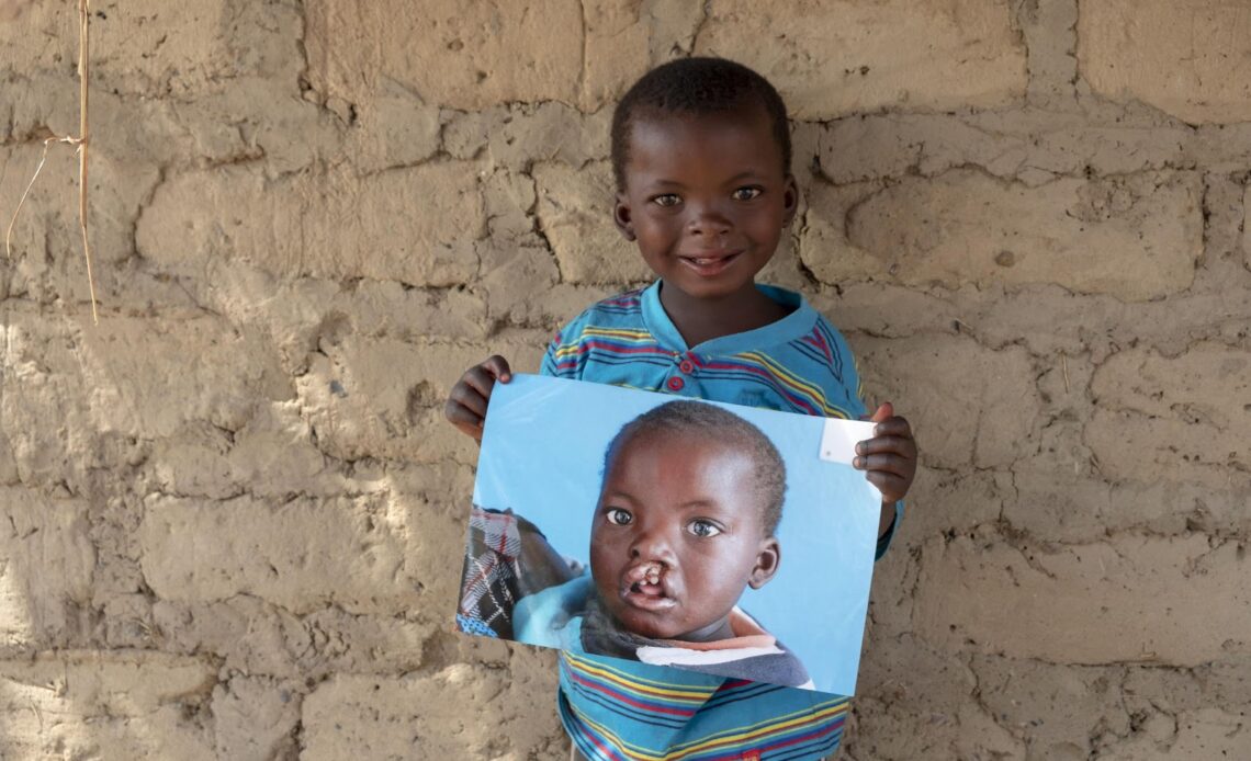 The truth about cleft lip and cleft palate: Tourism Focus